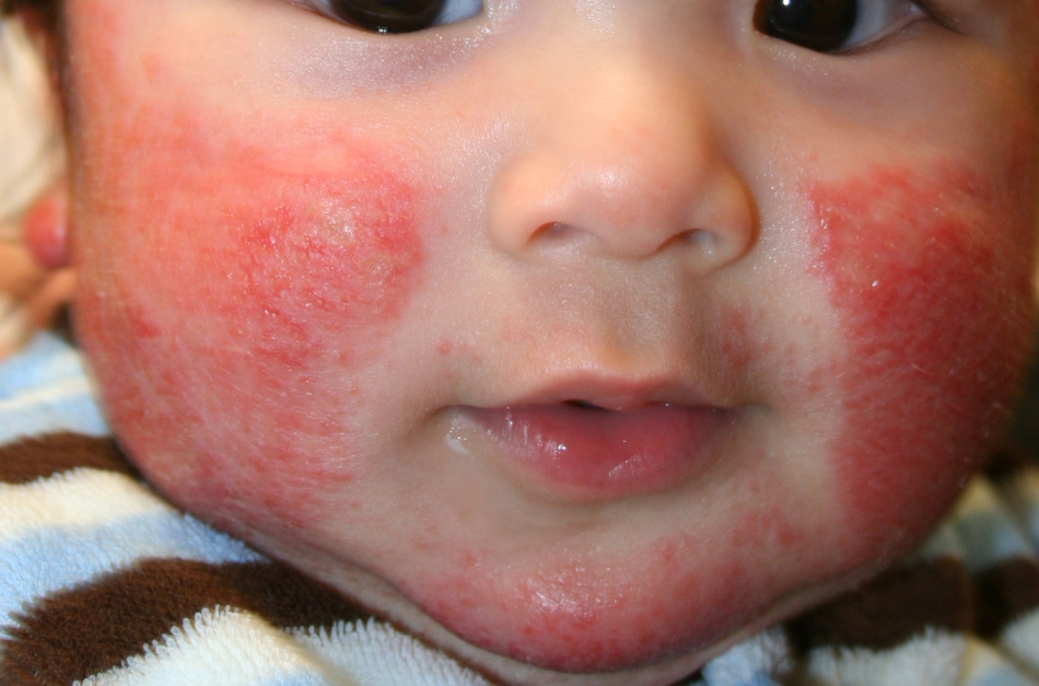Пятна и высыпания при аллергии у детей