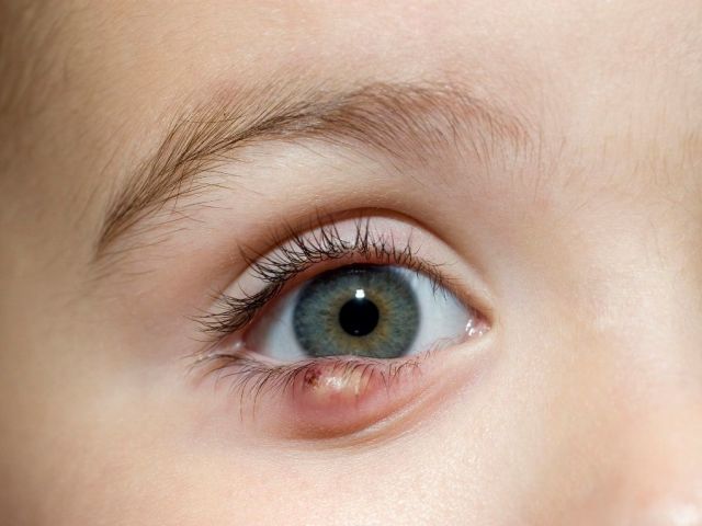 Πώς να αφαιρέσετε γρήγορα το κριθάρι από το μάτι, σε μια μέρα με ιατρικές και λαϊκές θεραπείες: συστάσεις, κατάλογος φαρμάκων, λαϊκές συνταγές