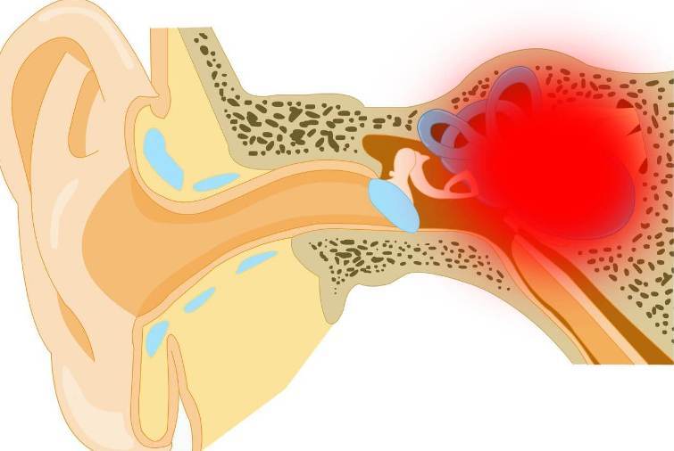 Inflammation de l'oreille moyenne: une grave complication de la grippe sur les oreilles