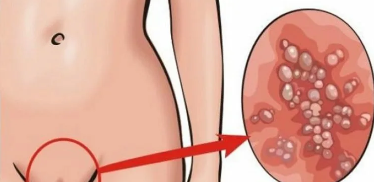 Virus papilloma manusia adalah penyebab jerawat pada pubis