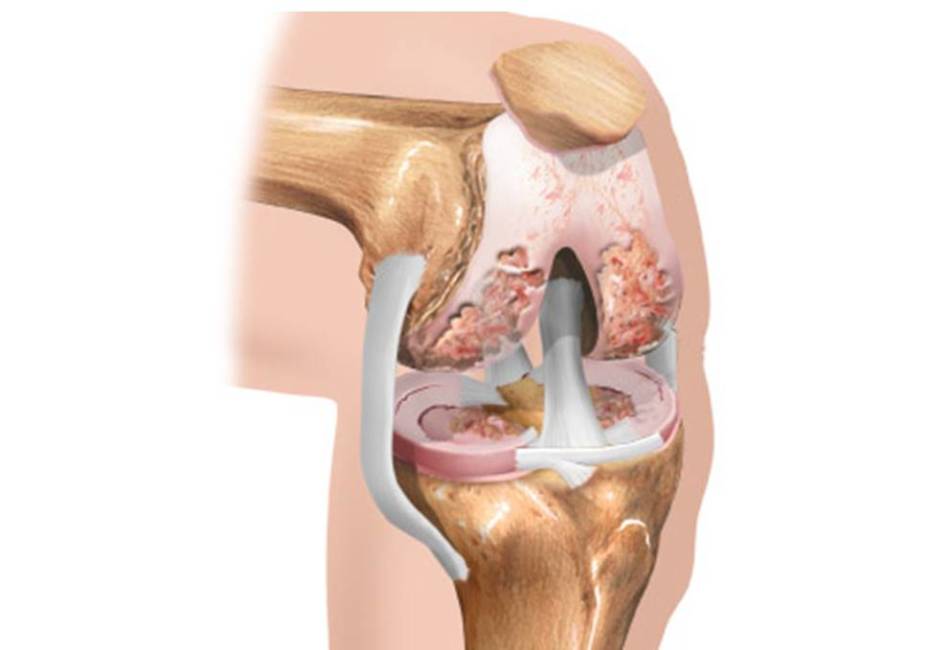 Damaged meniscus