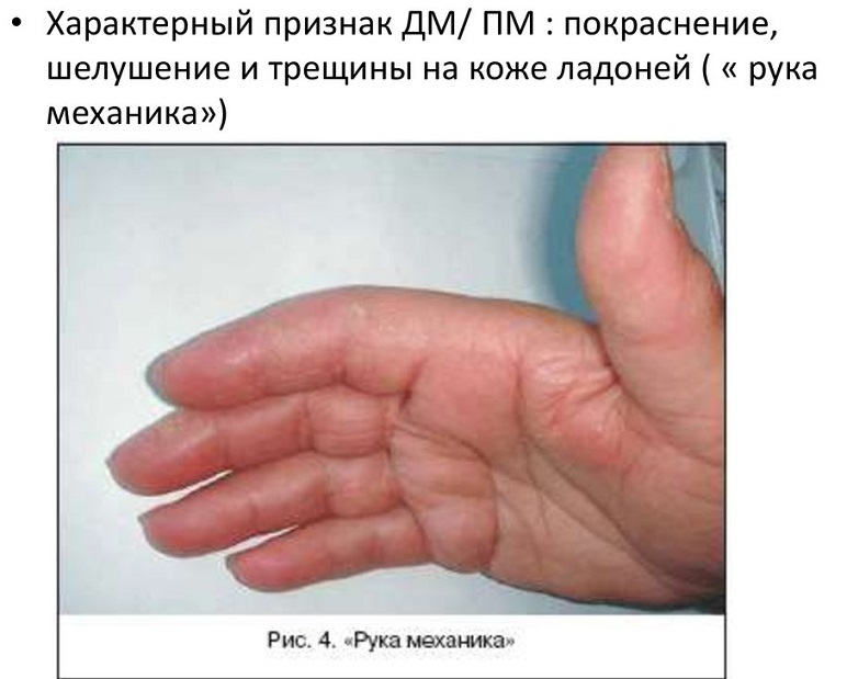Characteristic signs on the palms of the hands of dermatomyositis (DM) and polymiositis (PM)