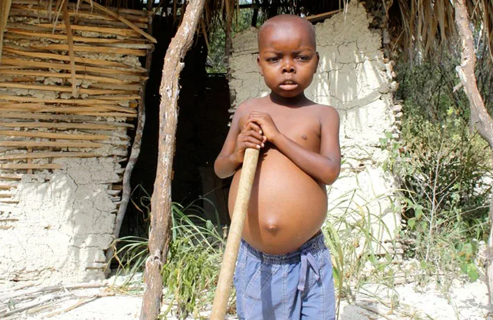 Kvashiorcor - un type de malnutrition