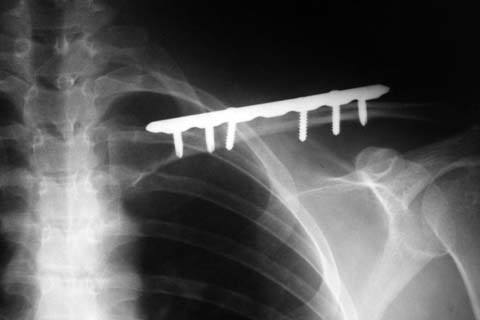 A plate with screws on the collarbone.