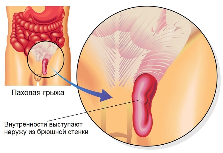 Yaichka hernia: symptoms and causes