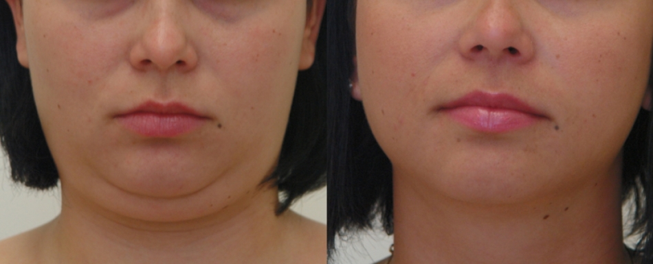 The second chin after laser lipolysis, photo before and after