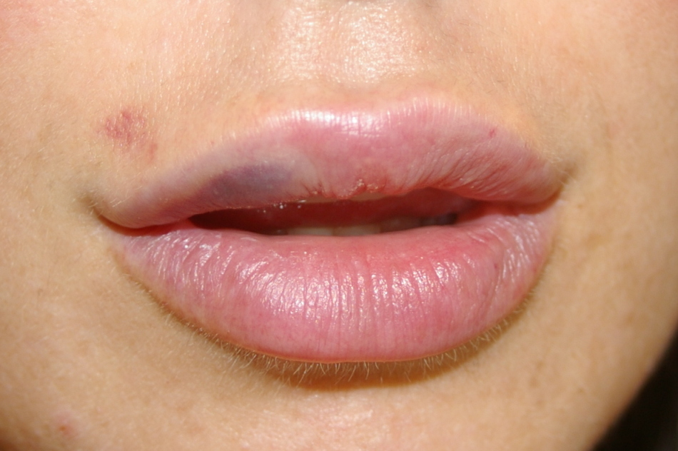 Hématomes après une façon radicale infructueuse d'élargir les lèvres