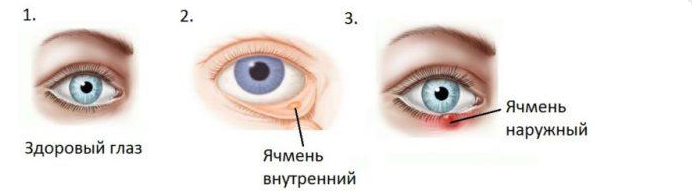Očesna bolezen - ječmen