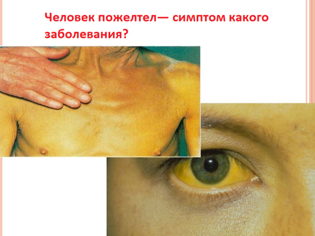 Ak osoba zalahla, aká môže byť choroba: Dôvody, čo robiť? Prečo koža, tvár, telo, oči človeka žltnú: Čo to znamená?