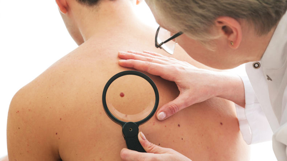 A lot of moles on the body may appear due to hormonal failure