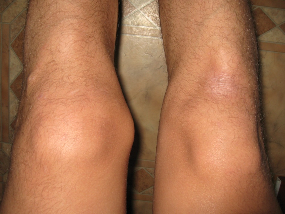 Affected by the knee