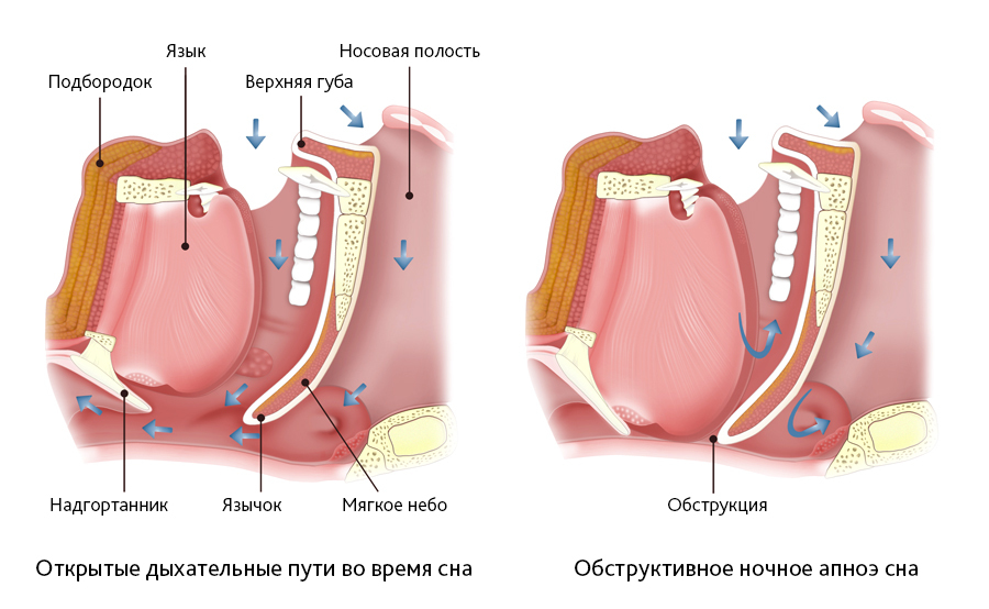 Apnea tidur obstruktif