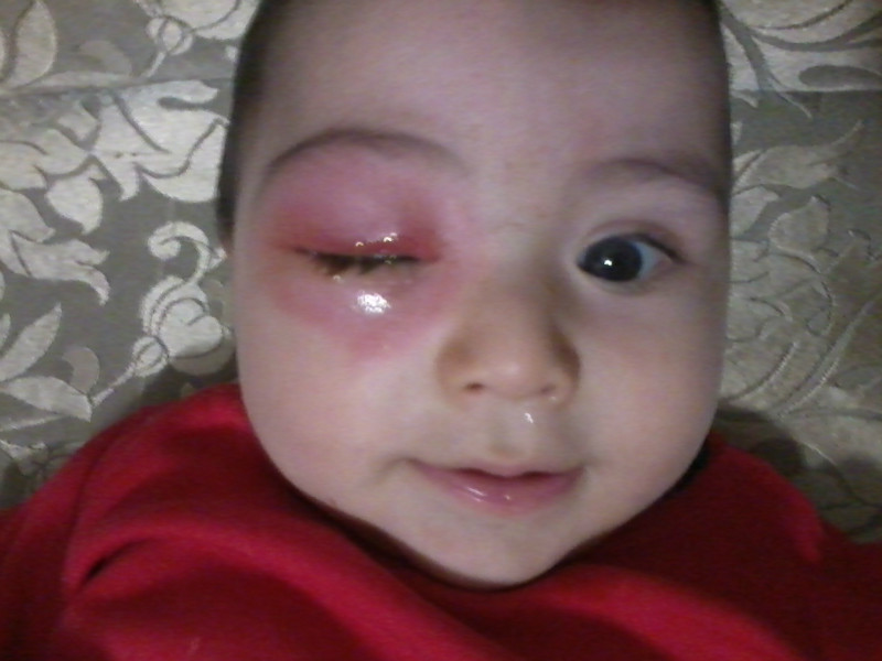From the bite of the mosquito, the eyelid is swollen in a child