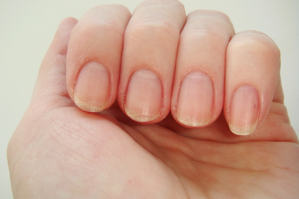 How to deal with dry skin around nails?