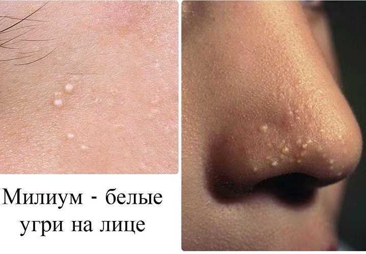 They are often taken for white acne
