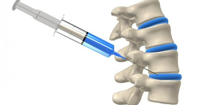 Blockade for back pain in the spine after sleep