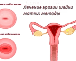 Erosion of the cervix - what it is: symptoms, signs, diagnosis. Modern treatment of cervical erosion in a gynecologist: radio waves, laser