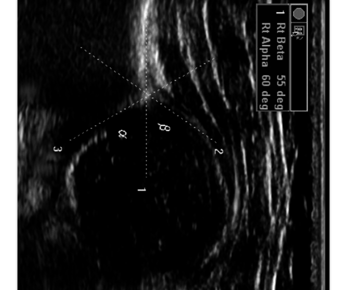 Ultrasound for the development of the hip joint