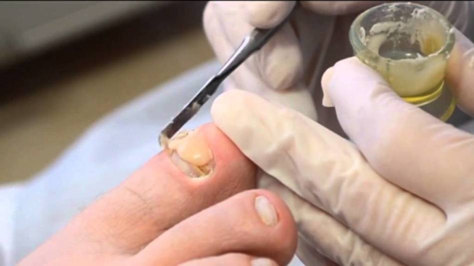 Polygel prosthetics of the pedicure