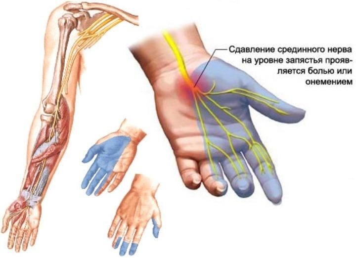 Expression of the disease