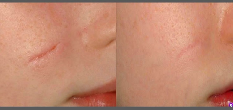 Odstranjevanje brazgotin na obrazu: pred in po njem