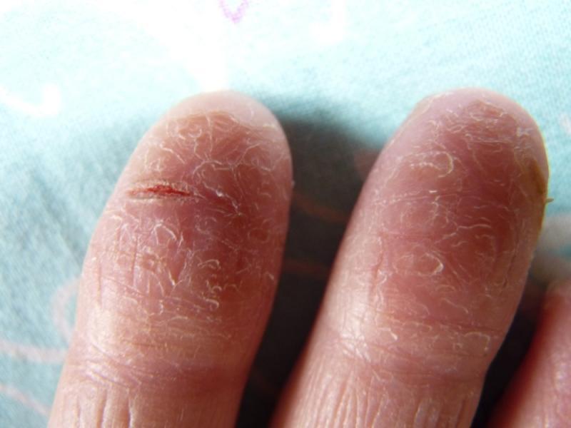 Dry skin on fingers and nails