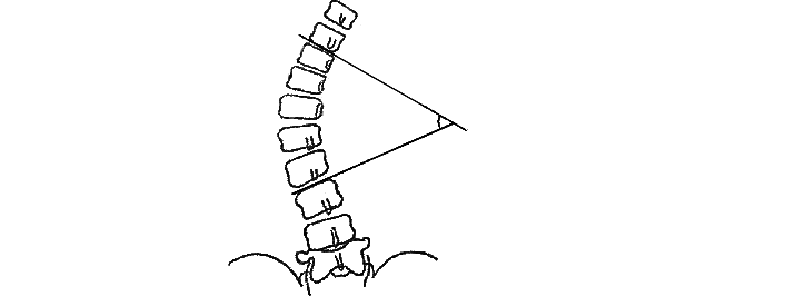 Method for determining the angle of scoliosis