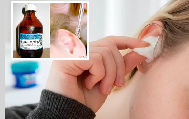 Hydrogen peroxide to remove traffic jams in the ear