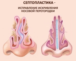 Courbure du septum nasal: vaut-il la peine et quelles complications sont possibles, traitement sans chirurgie