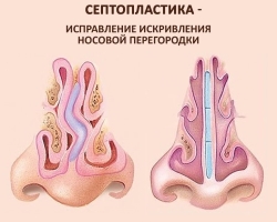 Zakrivenie nosného septa: stojí za to vykonať prevádzku a aké komplikácie sú možné, liečba bez operácie