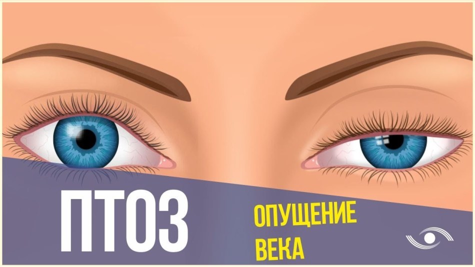 Опущение века