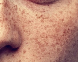 Hiperpigmentacija kože: vzroki in zdravljenje