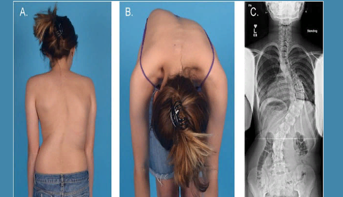 The degree of scoliosis is visible on the X -ray