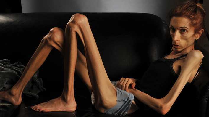 Anorexia is an insidious disease!