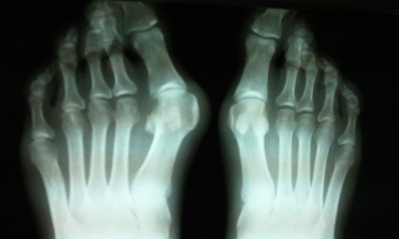 Отчего появляются шишки и косточки на пальцах ног, суставах? Как лечить шишку на большом пальце ноги без операции: средства от шишек на ногах
