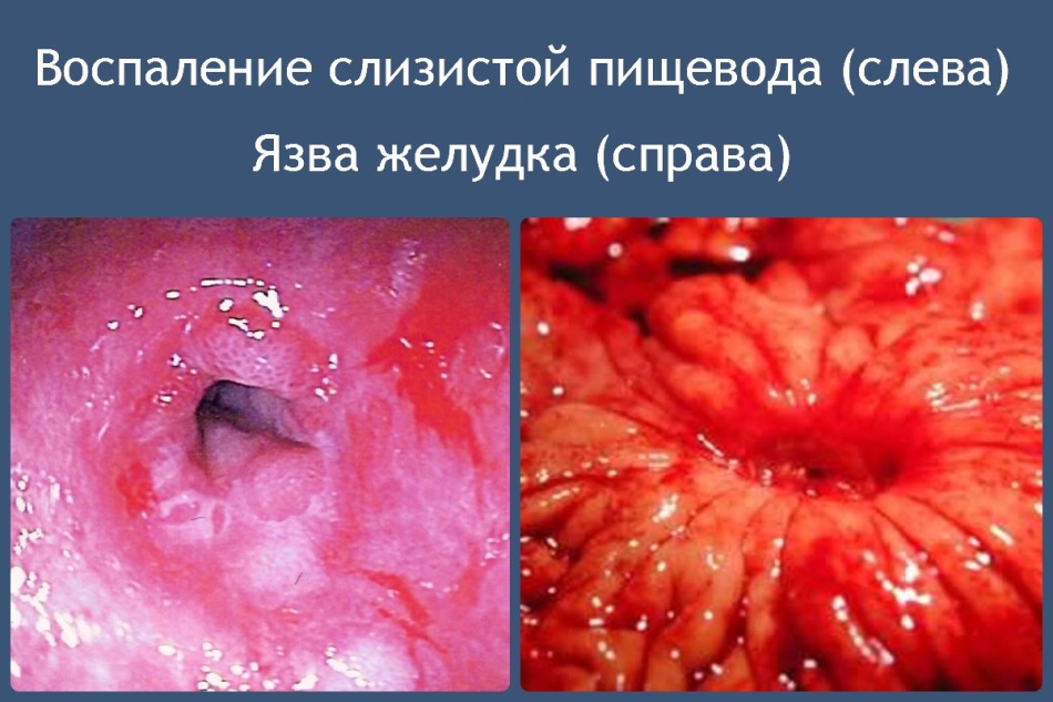 Проблемы пищеварительной системы