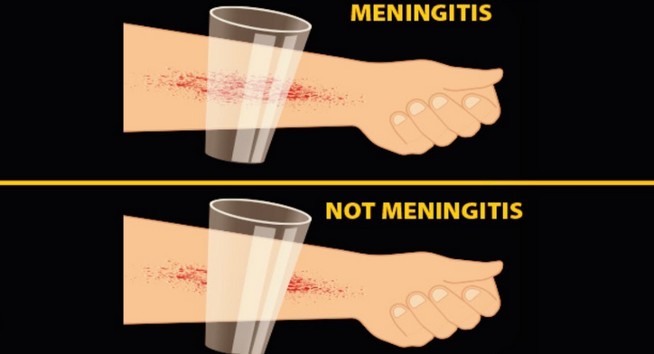 Поставить диагноз «менингит» без симптомов у взрослых и детей можно, приложив стакан к синякам или сыпи