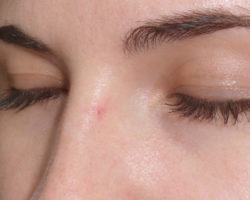 The skin is peeling under the eyebrows: Causes. What to do if the skin is peeling away: treatment