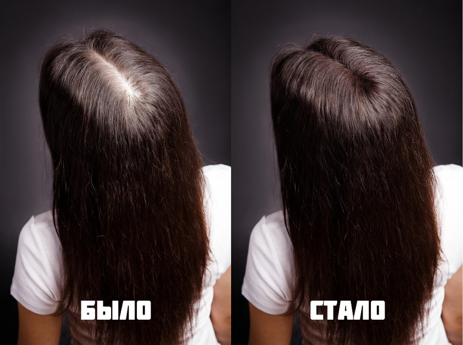 Hair growth after mesotherapy after three months