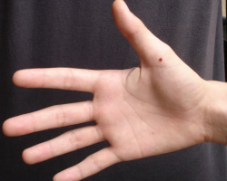 Mole on the thumb of the right or left hand - what will tell: meaning, signs