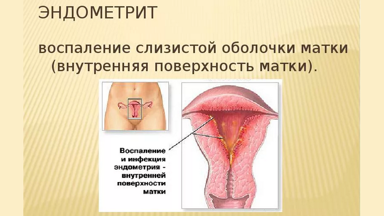 Эндометриоз в гинекологии