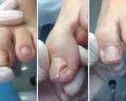 Onicholyse des ongles: qu'est-ce que c'est et comment traiter? Règles pour les prothèses des ongles sur l'onycholyse. Examen des prothèses d'outils pour l'onycholyse traumatique. Y a-t-il un champignon?
