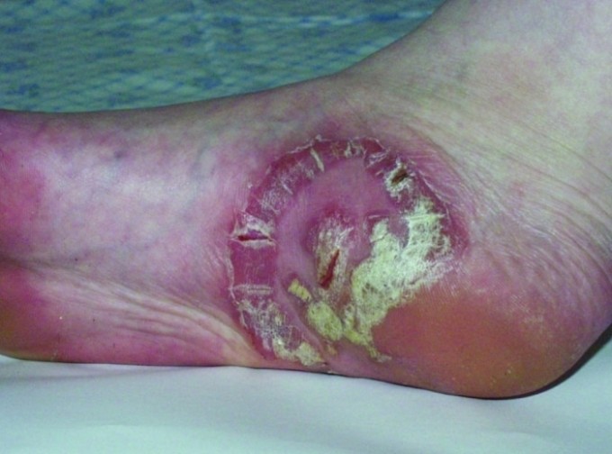 Syphilis sur les jambes