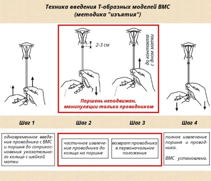 Внутриматочная спираль схема