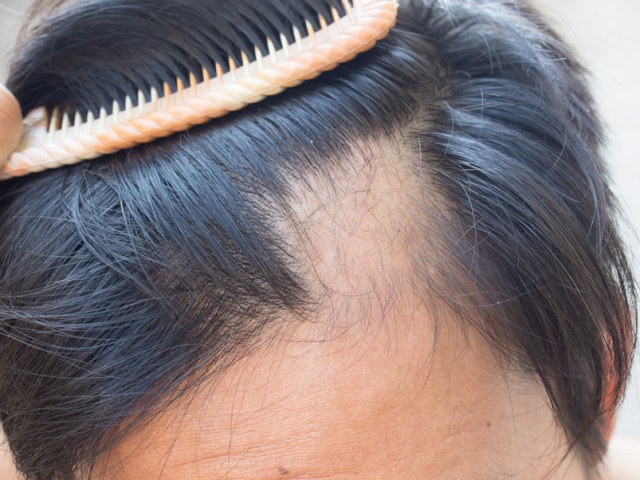 Що робити, якщо лисий - алопеція: симптоми, причини, продукти лікування, маски росту волосся, профілактика. Що робити з сильним випаданням волосся після коронавірусу?