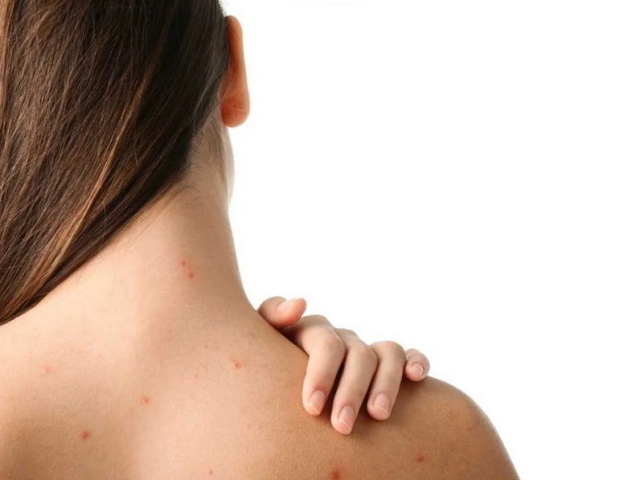 Akne na hrbtni strani deklet in žensk: Znaki, za katere je odgovoren organ