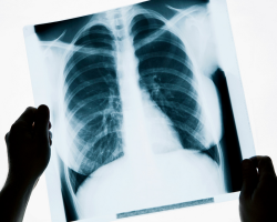What can show fluorography of the chest, what diseases? Does fluorography show the lesion of the lungs in coronavirus?