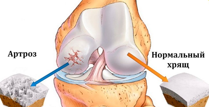 Arthrosis sendi lutut