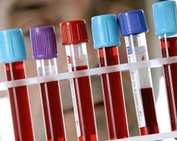 Blood biochemistry - deciphering results in adults, men, women, children, during pregnancy: the norm in the table. How to prepare and take a blood test for biochemistry correctly, how many days is it done in the clinic?