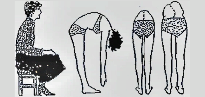 Determinación de la escoliosis por longitud de la pierna